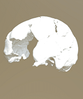 3D model of the Paget skull