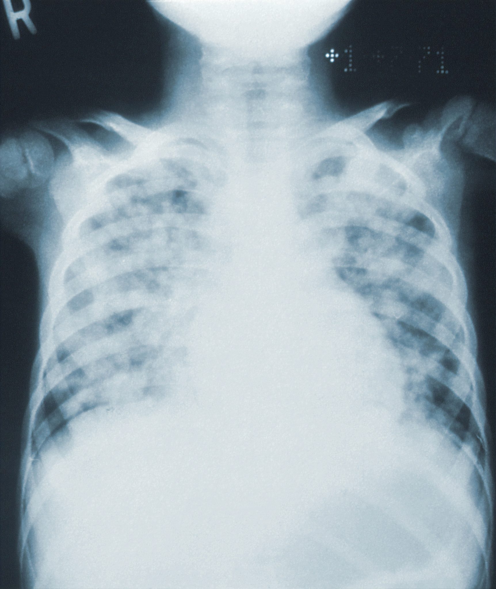 X-Ray of Lungs